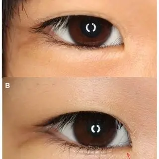 Low Eyelid Crease